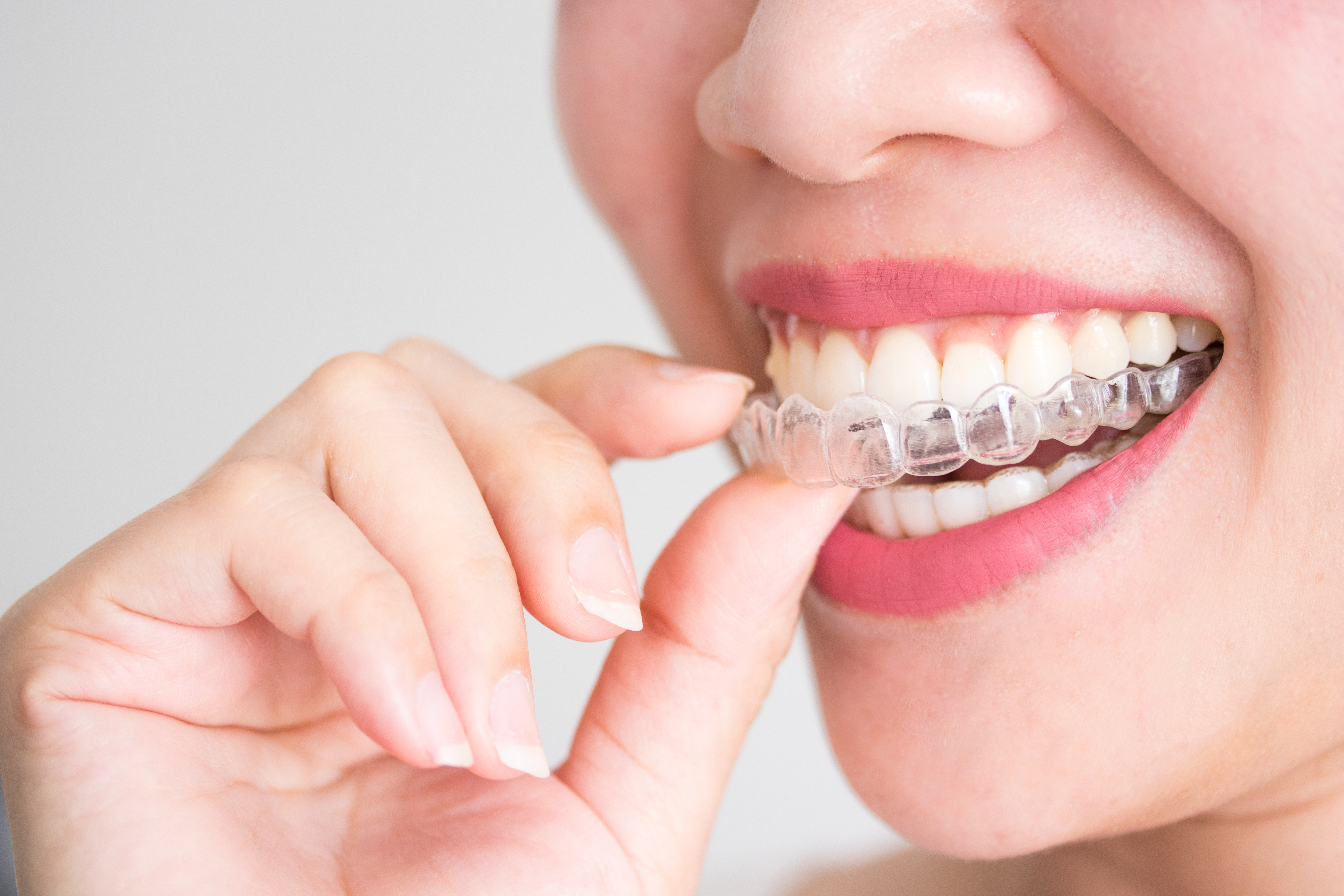 Invisalign : Orthodontie et appareil dentaire invisible - GUIDE - Dentego
